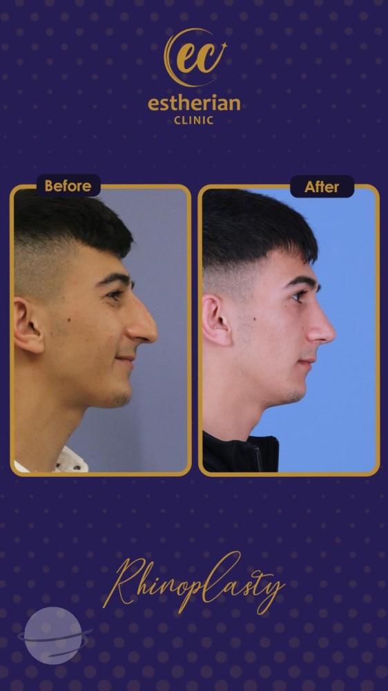 estherian Face Surgery 17-min