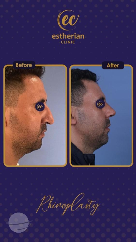 estherian Face Surgery 19-min