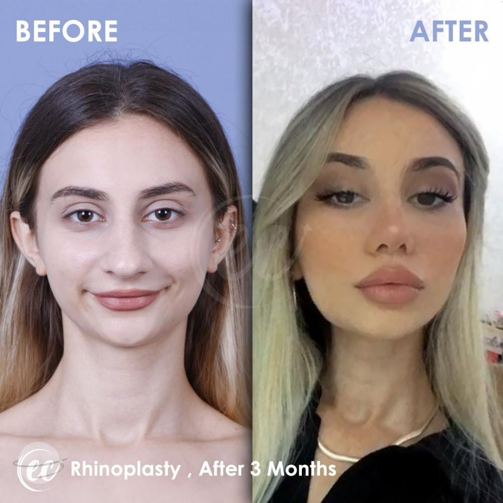 estherian Face Surgery 22-min
