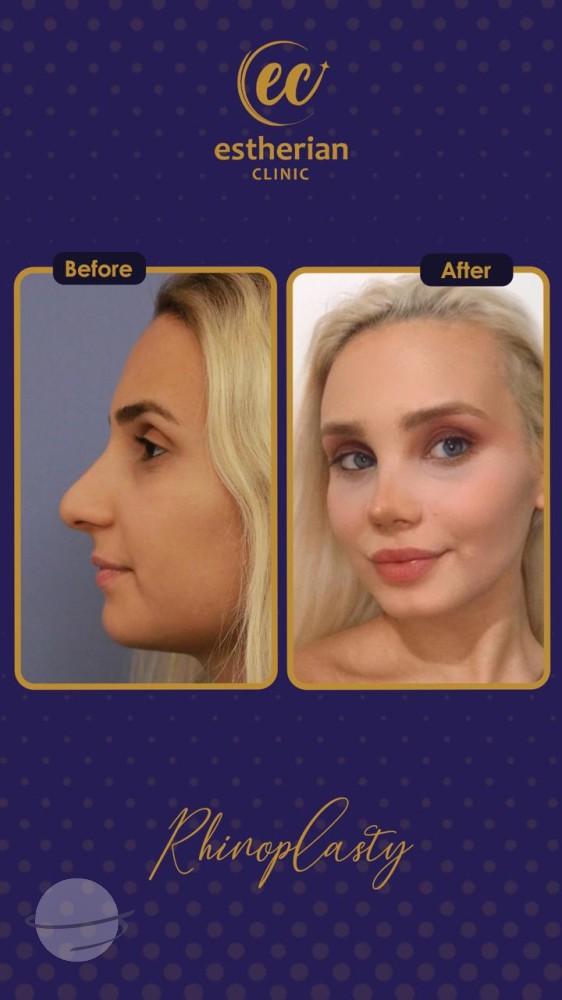 estherian Face Surgery 25-min