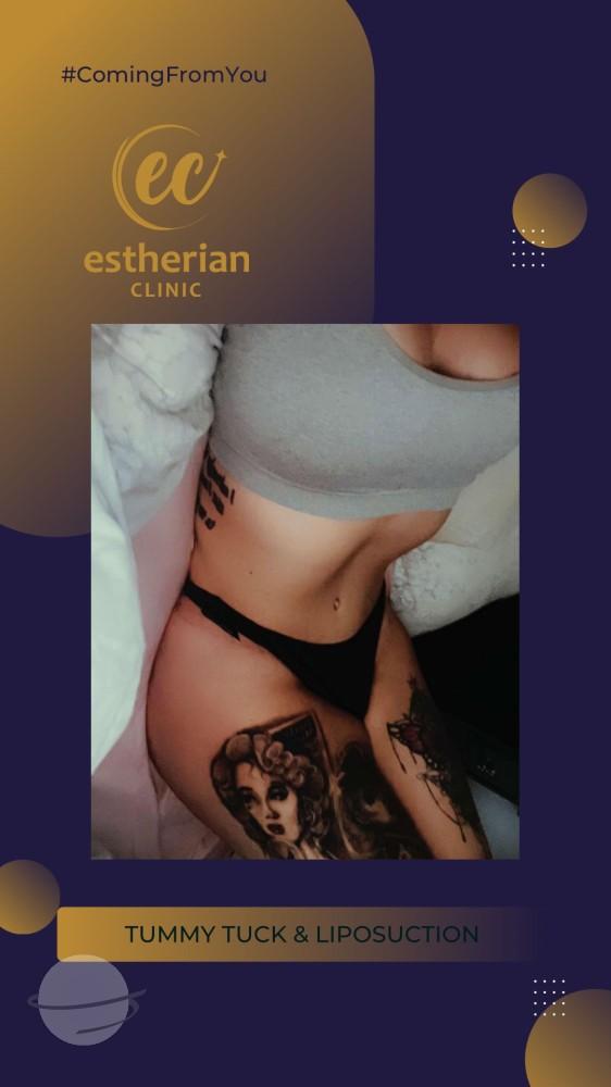 estherian BODY Surgery 18-min
