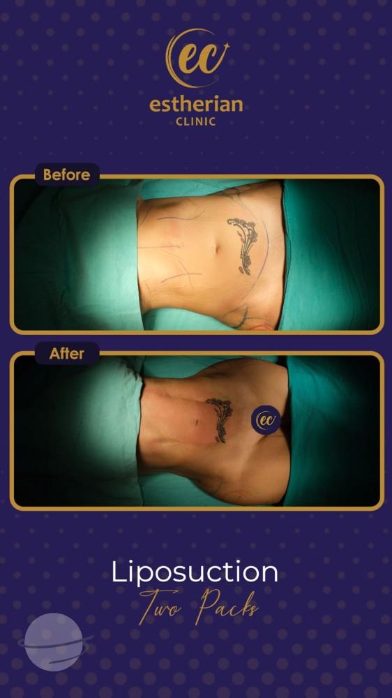 estherian BODY Surgery 12-min