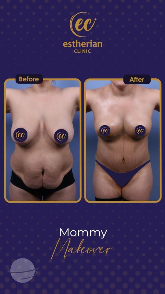estherian BODY Surgery 13-min