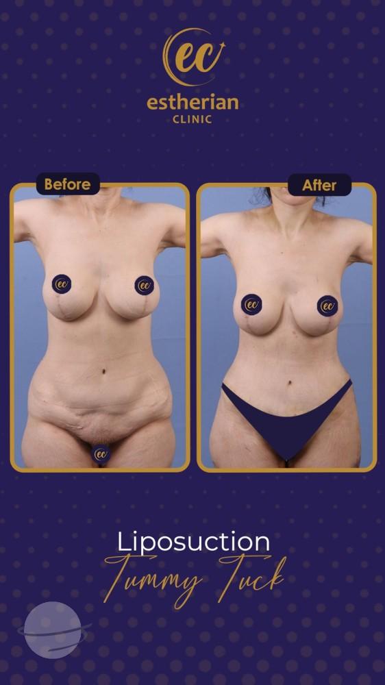 estherian BODY Surgery 14-min