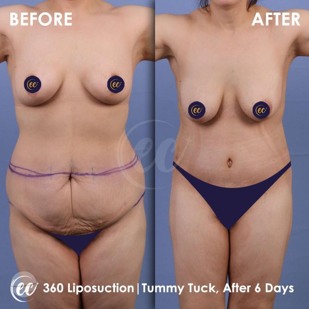 estherian BODY Surgery 5-min