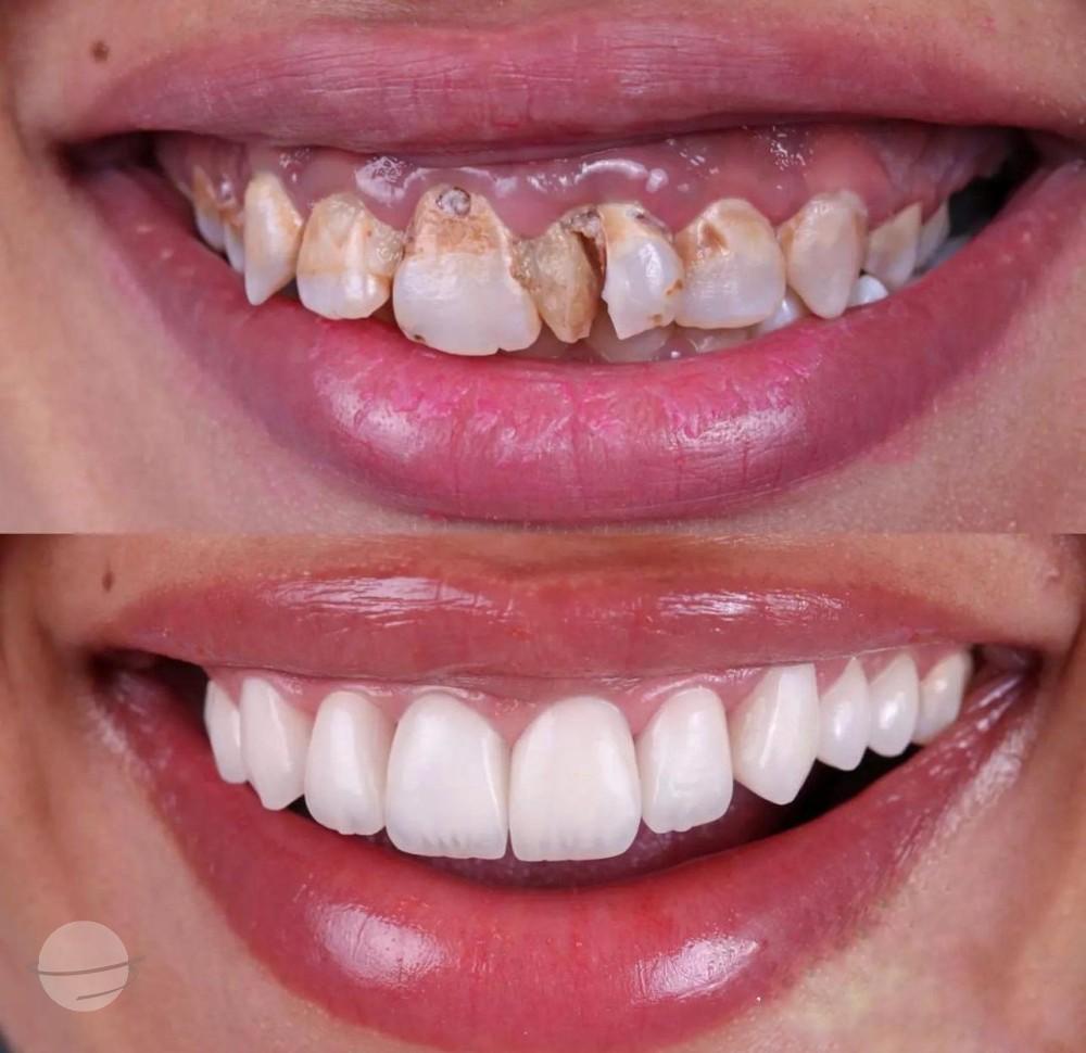 12- Before-after zirkon vaka