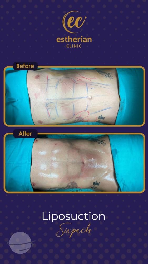 estherian BODY Surgery 15-min