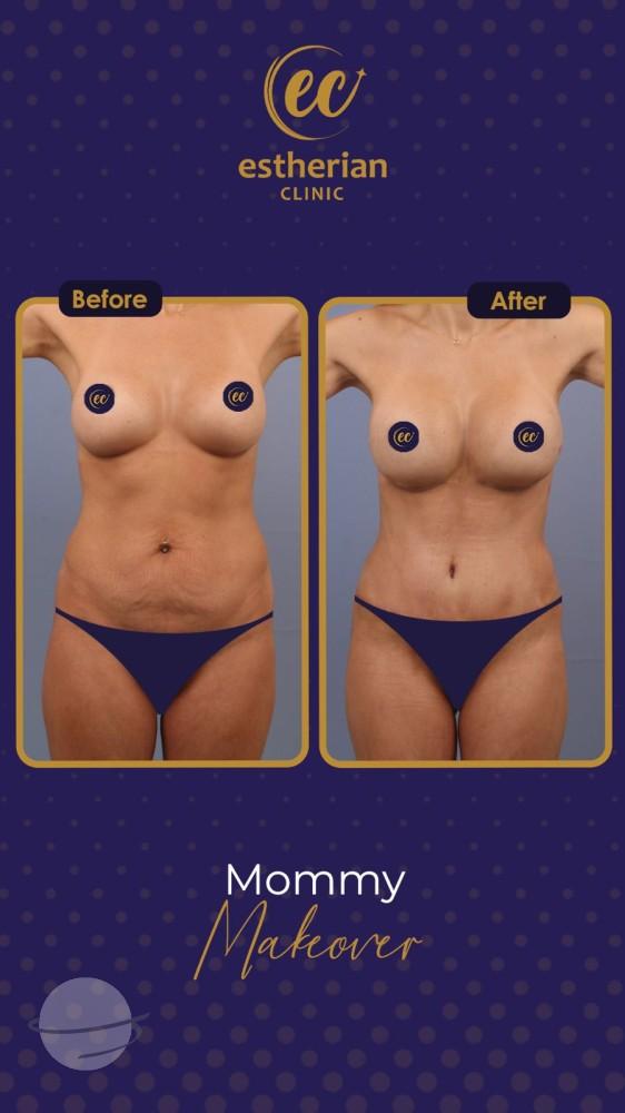 estherian BODY Surgery 16-min