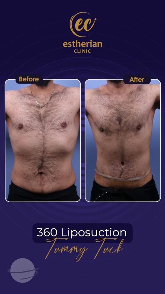 estherian BODY Surgery 17-min