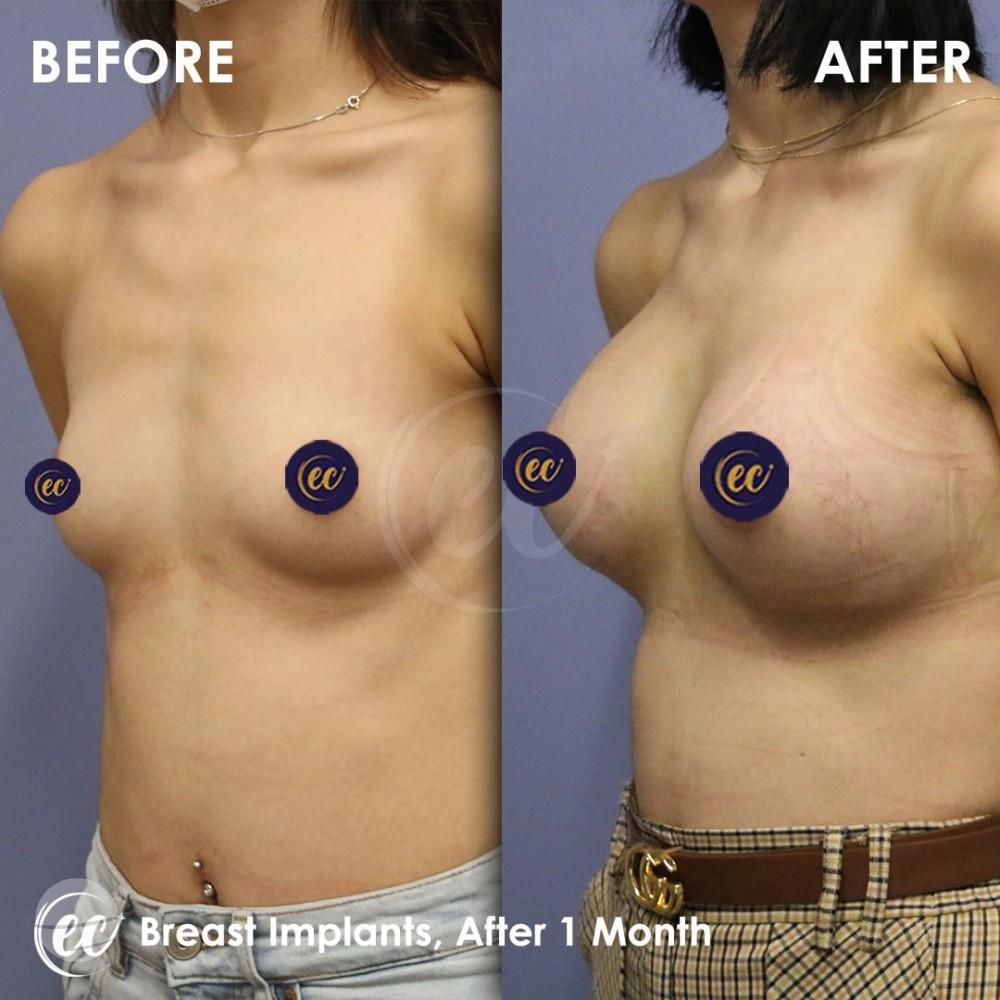 estherian Breast Surgery 5