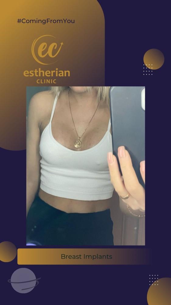 estherian Breast Surgery 7