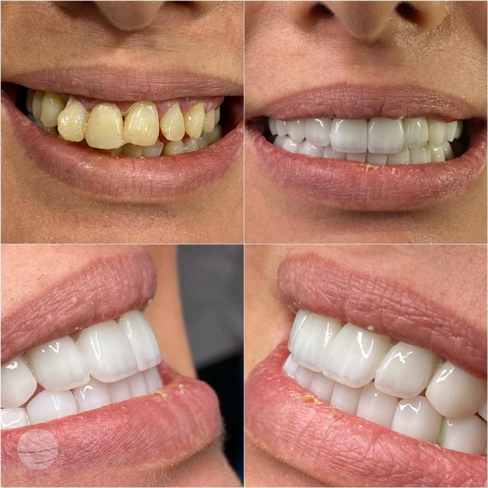 19- Before-after zirkon vaka