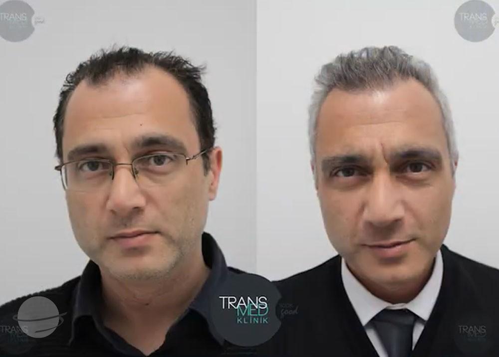 Transmed Hair Clinic result