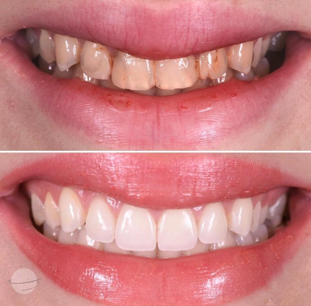 11- Before-after zirkon vaka