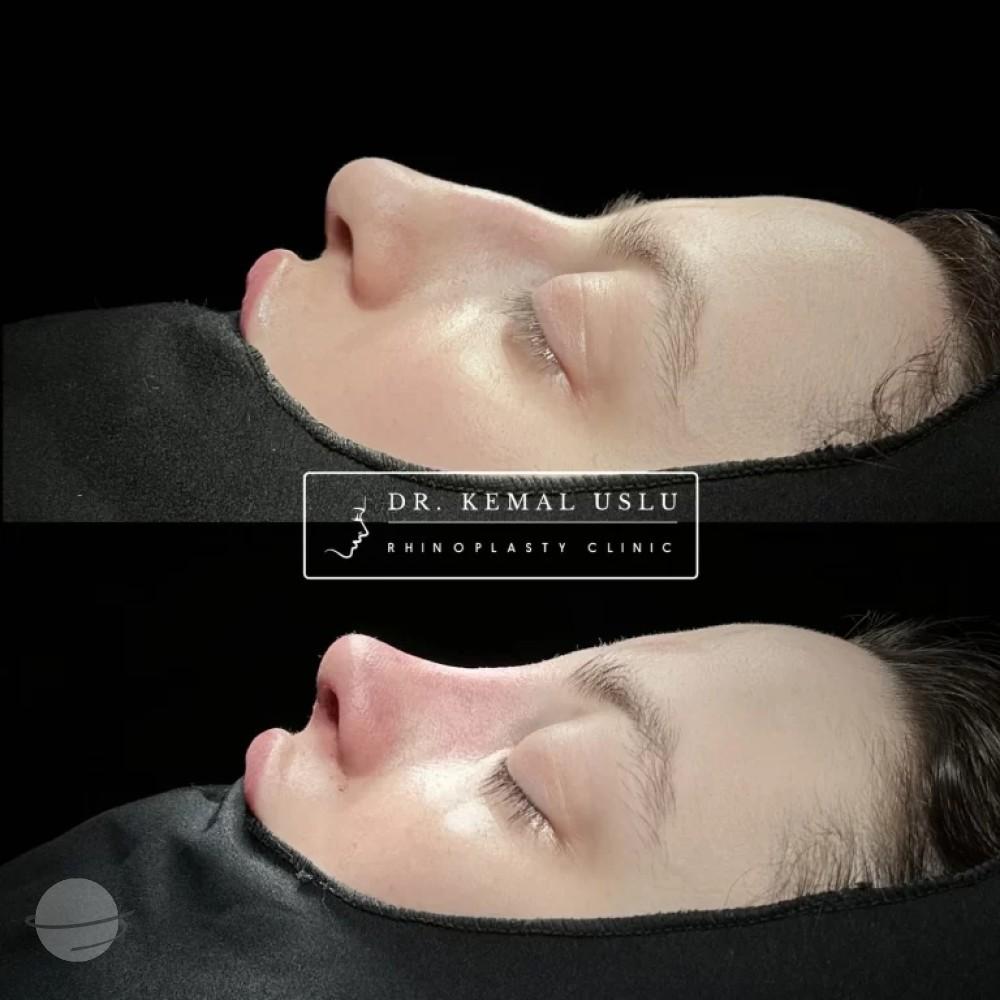 Dr Kemal Uslu Rhinoplasty
