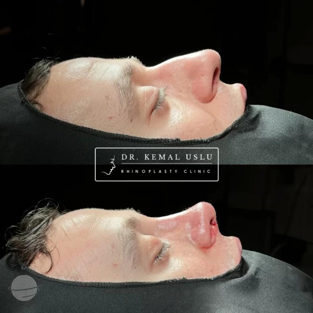 Dr Kemal Uslu Rhinoplasty
