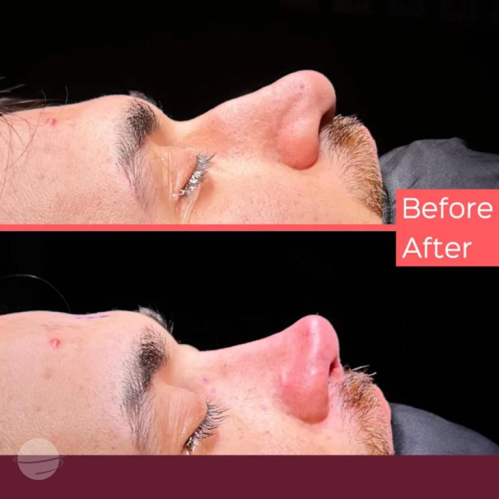 Dr Kemal Uslu Rhinoplasty