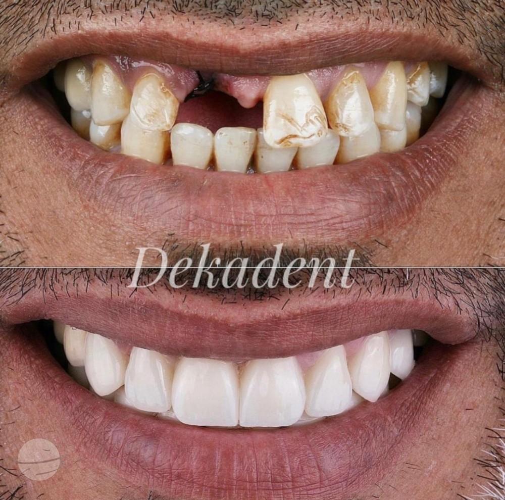 15- Before-after zirkon vaka