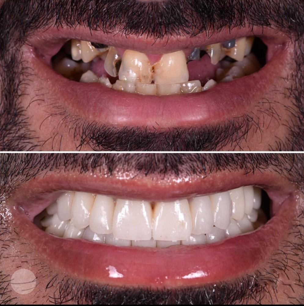 16- Before-after zirkon vaka