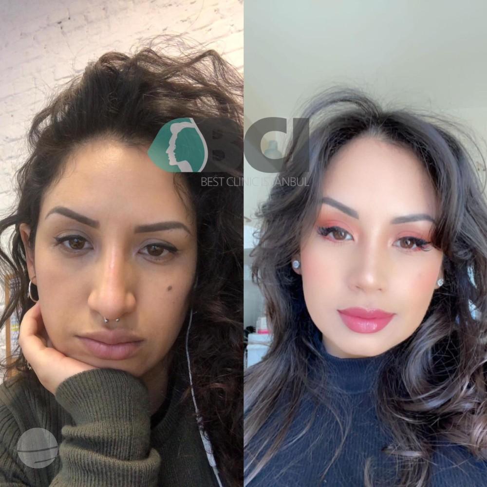 ELIT CLINIC COSMETIC SURGERY RESULTS 9