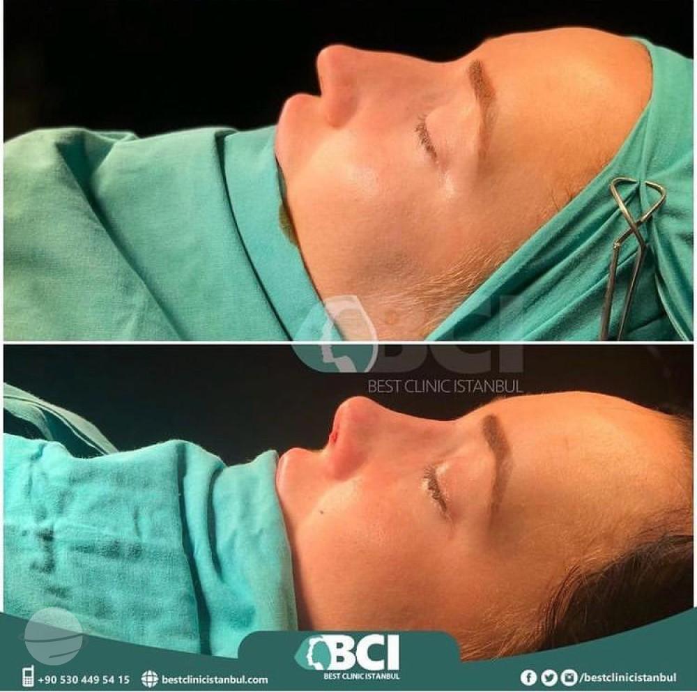 ELIT CLINIC COSMETIC SURGERY RESULTS 10