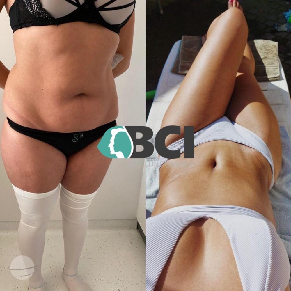 ELIT CLINIC COSMETIC SURGERY RESULTS 18