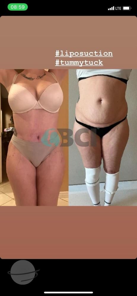 ELIT CLINIC COSMETIC SURGERY RESULTS 15