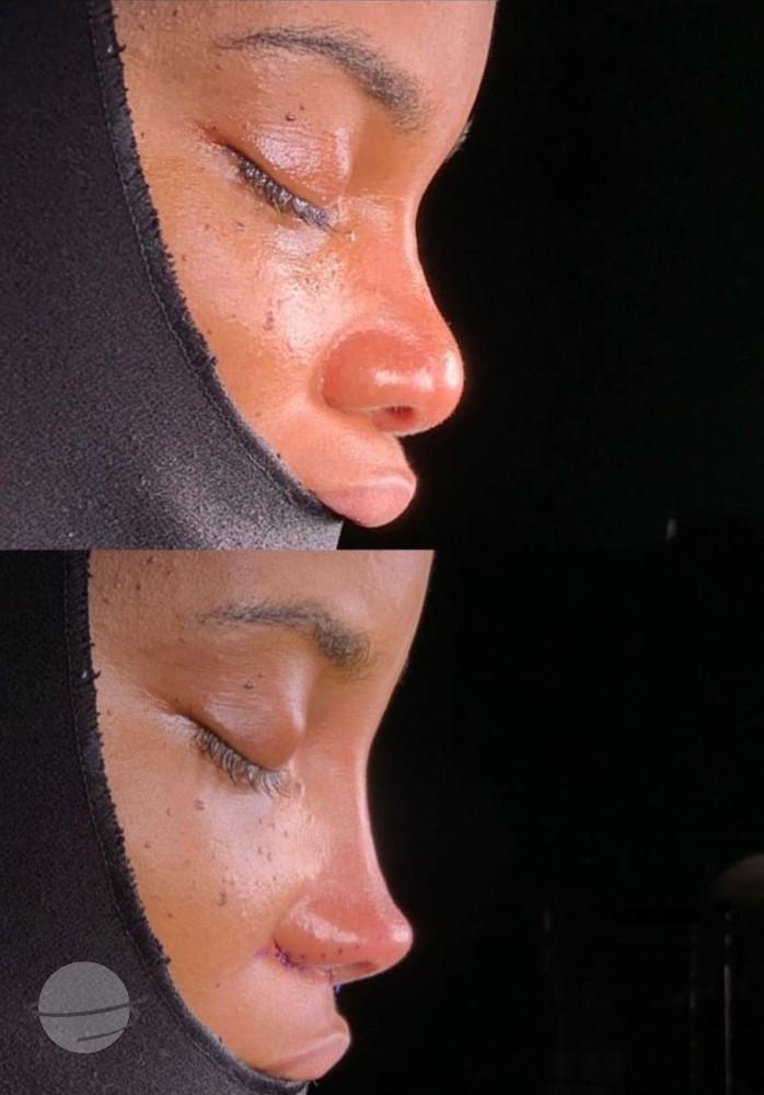 Dr Kemal Uslu Rhniplastie Ethnique - Etnic rhino4