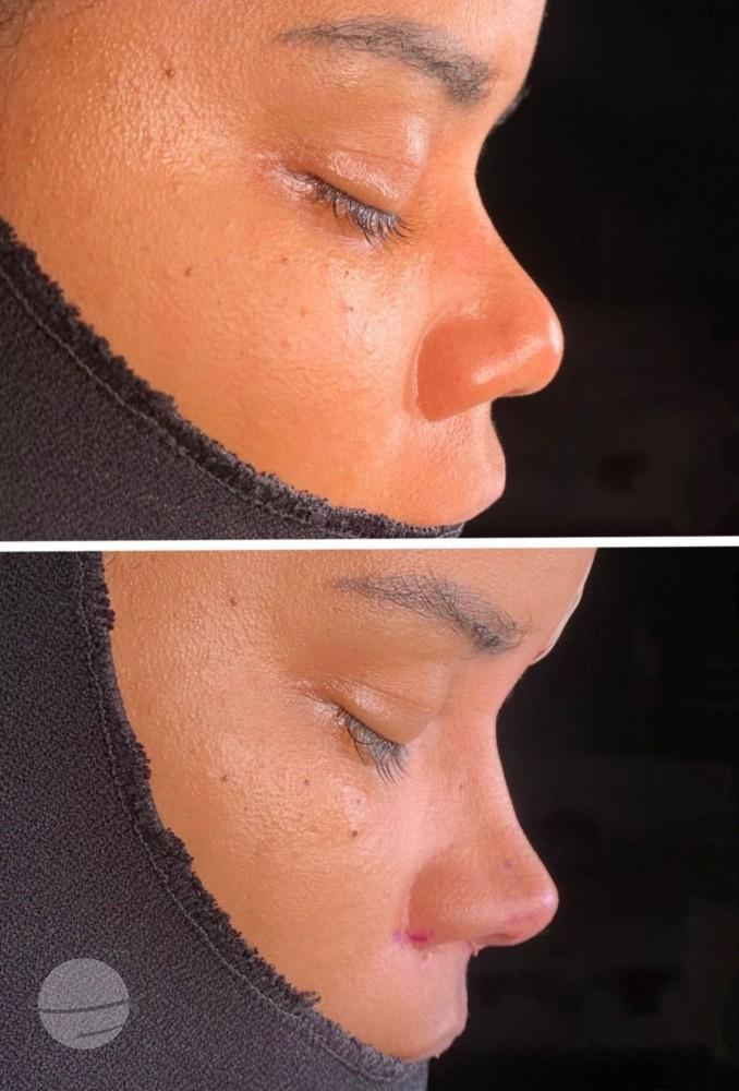 Dr Kemal Uslu Rhniplastie Ethnique - Etnic rhino5