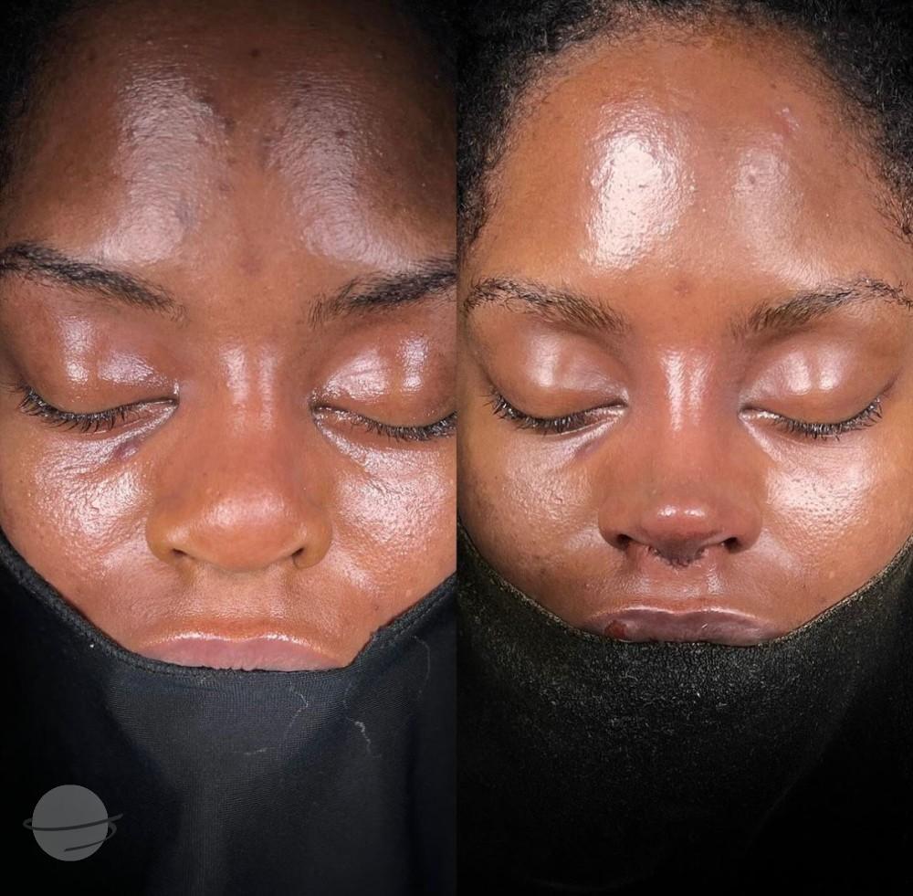 Dr Kemal Uslu Rhniplastie Ethnique - Etnic rhino9