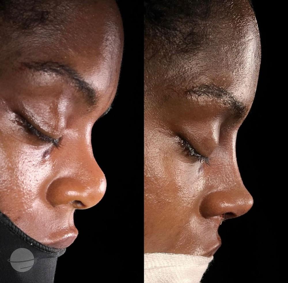 Dr Kemal Uslu Rhniplastie Ethnique - Etnic rhino10