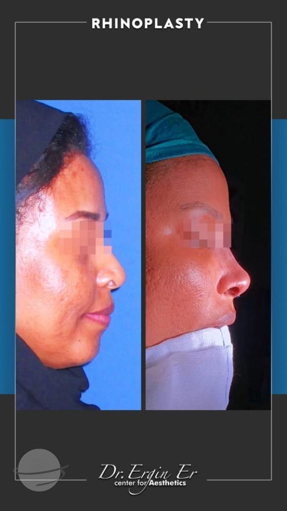 DR ERGIN ER ISTANBUL RHINOPLASTY6