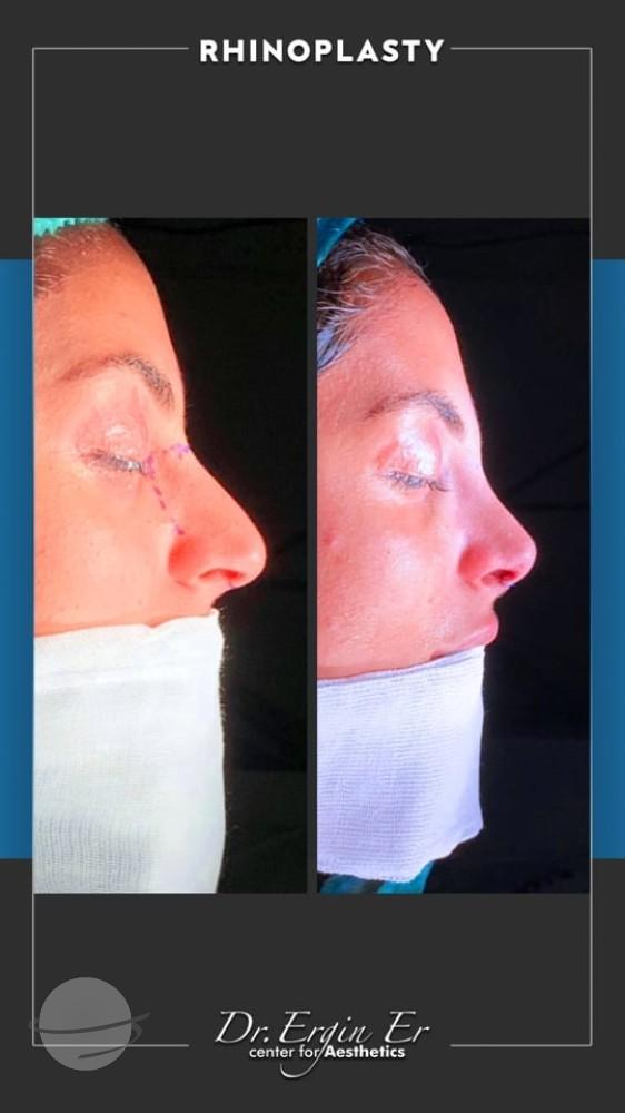 DR ERGIN ER ISTANBUL RHINOPLASTY5
