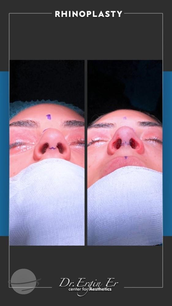 DR ERGIN ER ISTANBUL RHINOPLASTY4
