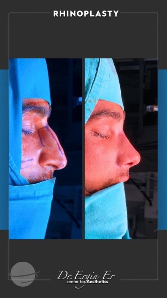 DR ERGIN ER ISTANBUL RHINOPLASTY2