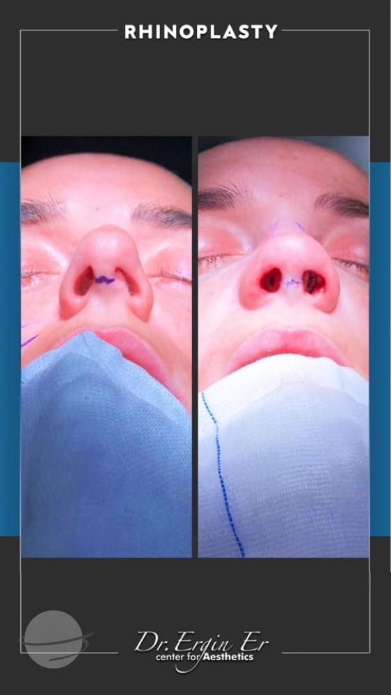 DR ERGIN ER ISTANBUL RHINOPLASTY7