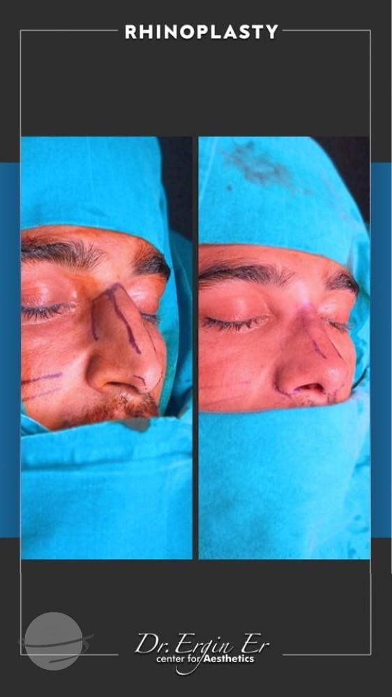 DR ERGIN ER ISTANBUL RHINOPLASTY1
