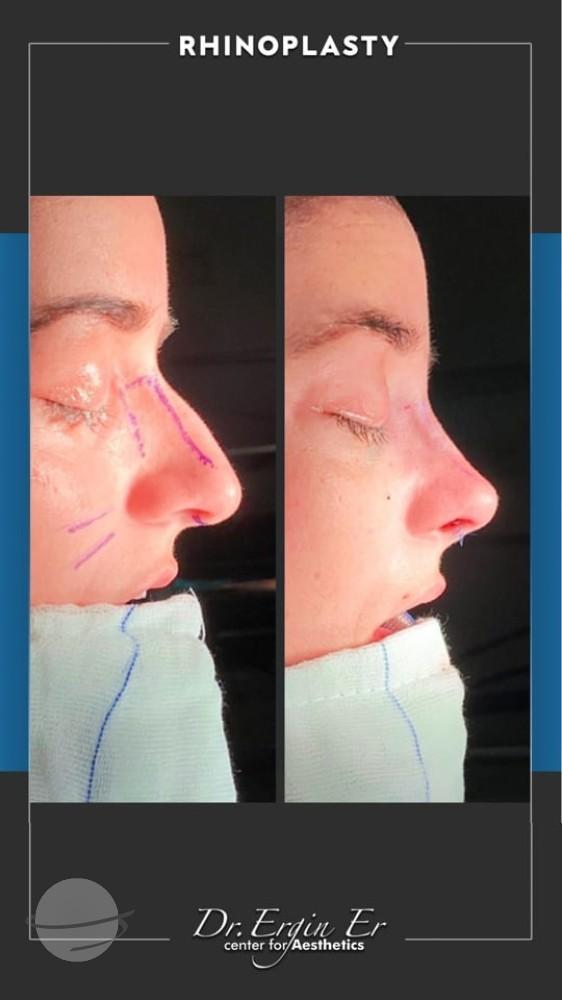 DR ERGIN ER ISTANBUL RHINOPLASTY8