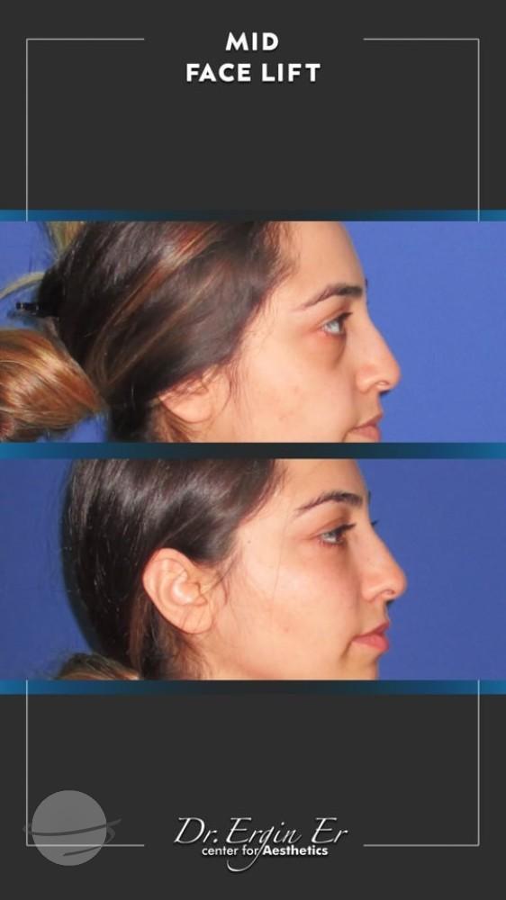 DR ERGIN ER ISTANBUL RESULTS SURGERY 36