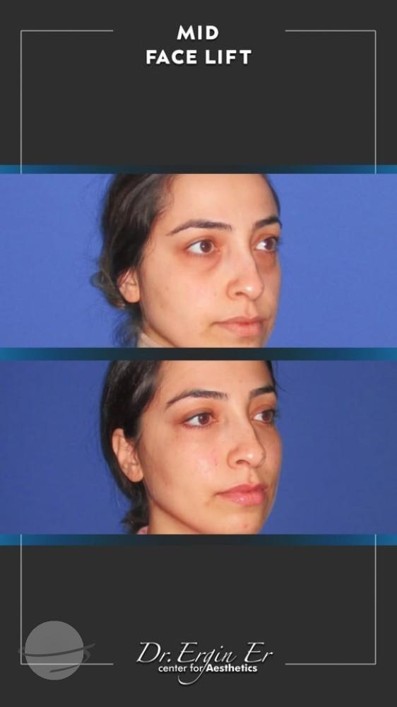 DR ERGIN ER ISTANBUL RESULTS SURGERY 39