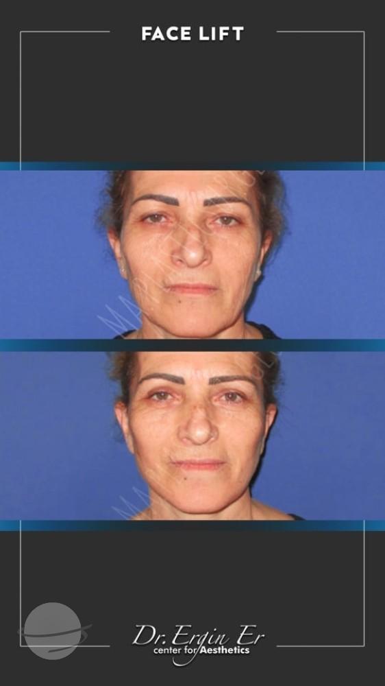 DR ERGIN ER ISTANBUL RESULTS SURGERY 24