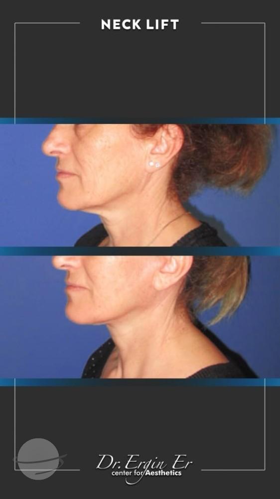 DR ERGIN ER ISTANBUL RESULTS SURGERY 33