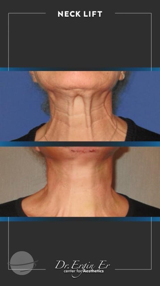 DR ERGIN ER ISTANBUL RESULTS SURGERY 31