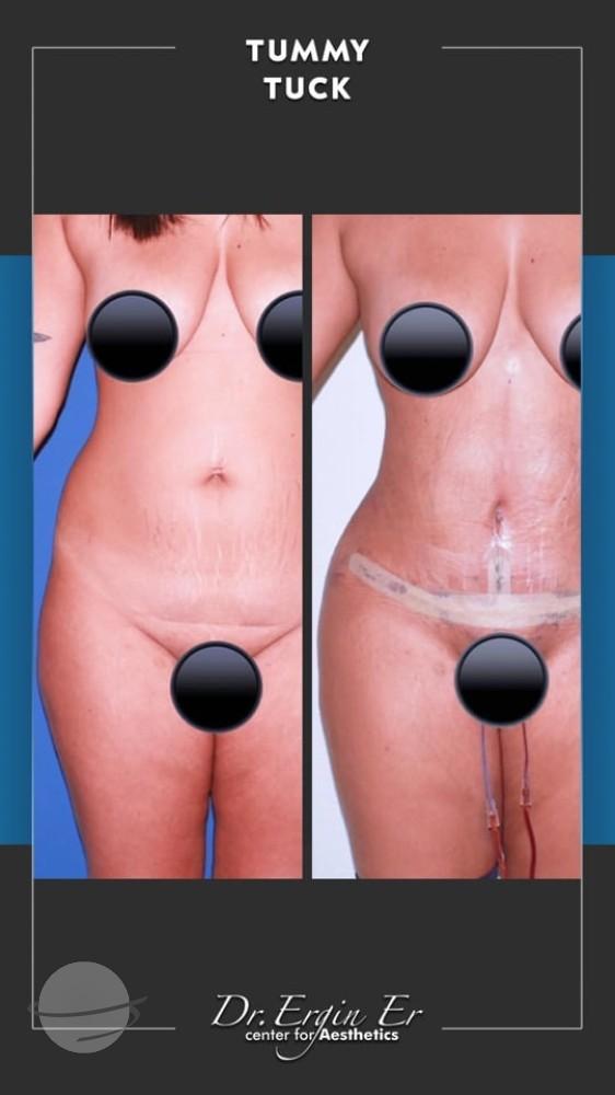 DR ERGIN ER ISTANBUL RESULTS SURGERY 38