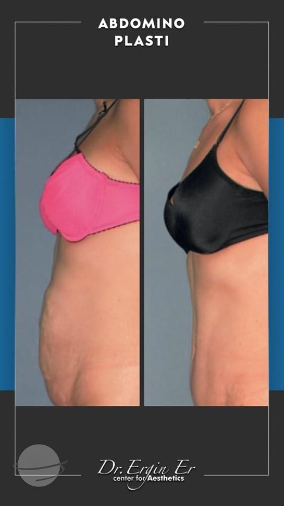 DR ERGIN ER ISTANBUL RESULTS SURGERY 23