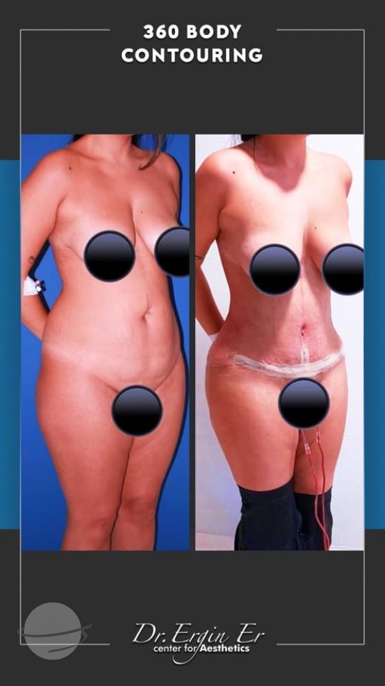 DR ERGIN ER ISTANBUL RESULTS SURGERY 40