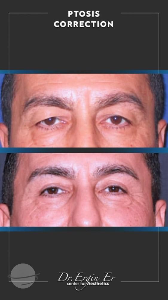 DR ERGIN ER ISTANBUL RESULTS SURGERY 18