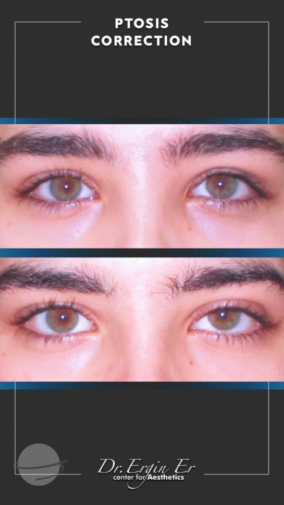 DR ERGIN ER ISTANBUL RESULTS SURGERY 34