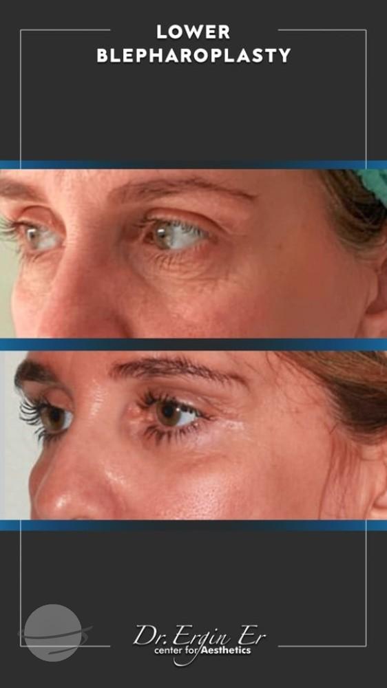 DR ERGIN ER ISTANBUL RESULTS SURGERY 16