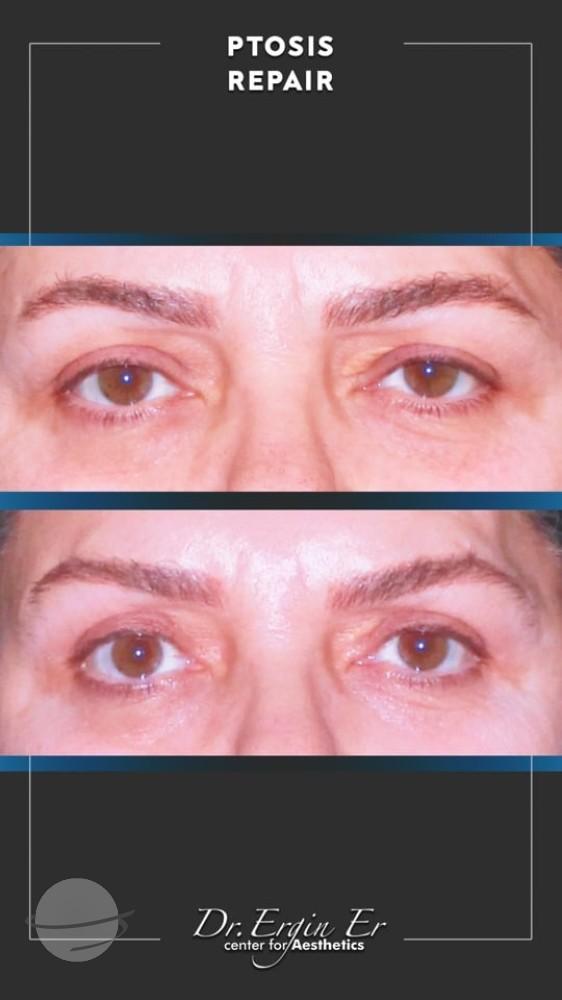 DR ERGIN ER ISTANBUL RESULTS SURGERY 11